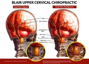 Blair upper cervical chiropractic